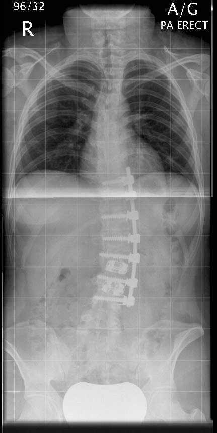 Anterior Scoliosis X-ray